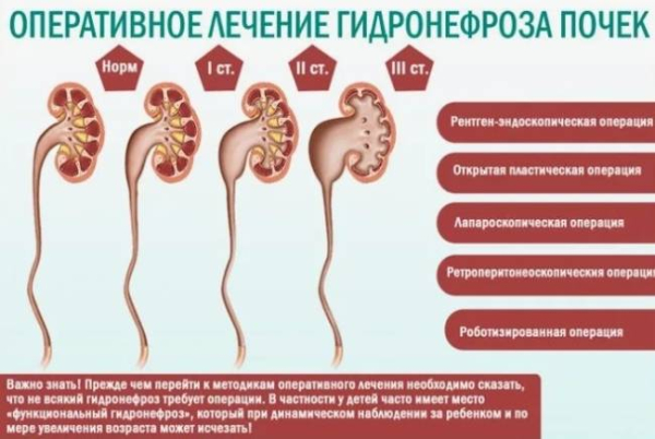 Что такое гидронефроз одной почки