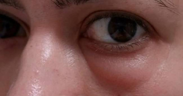 Причины отечности под глазами Причины отечности под глазами